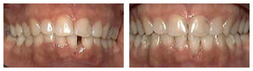 invisalign